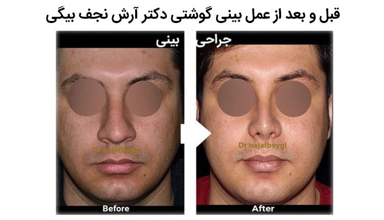 قبل و بعد از جراحی بینی گوشتی دکتر  آرش نجف بیگی