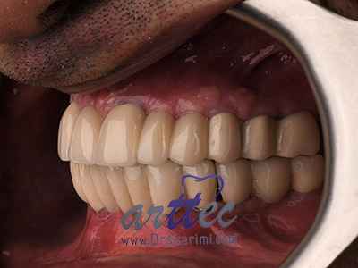Dental implant methods
