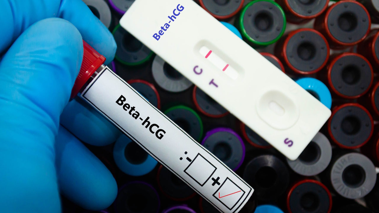 تشخیص بارداری با آزمایش خون
