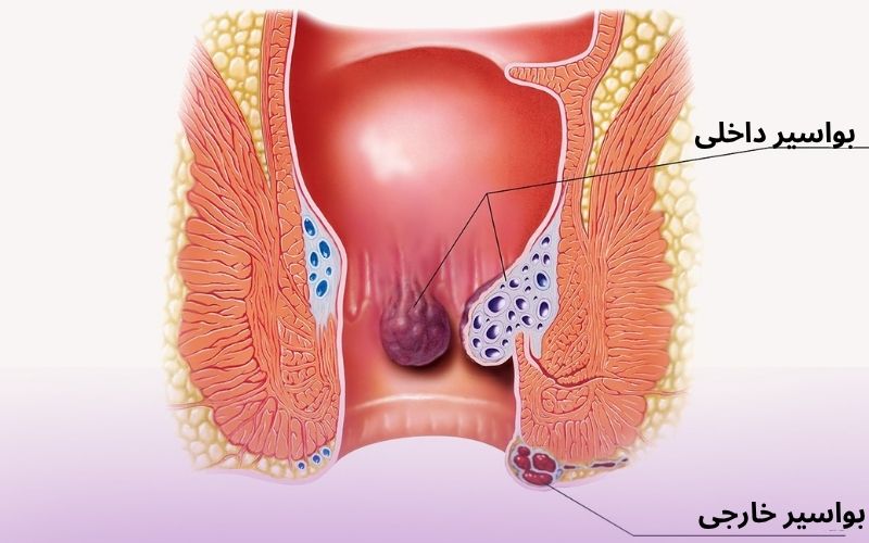 بواسیر در بارداری