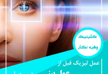 جراحی لیزیک چشم