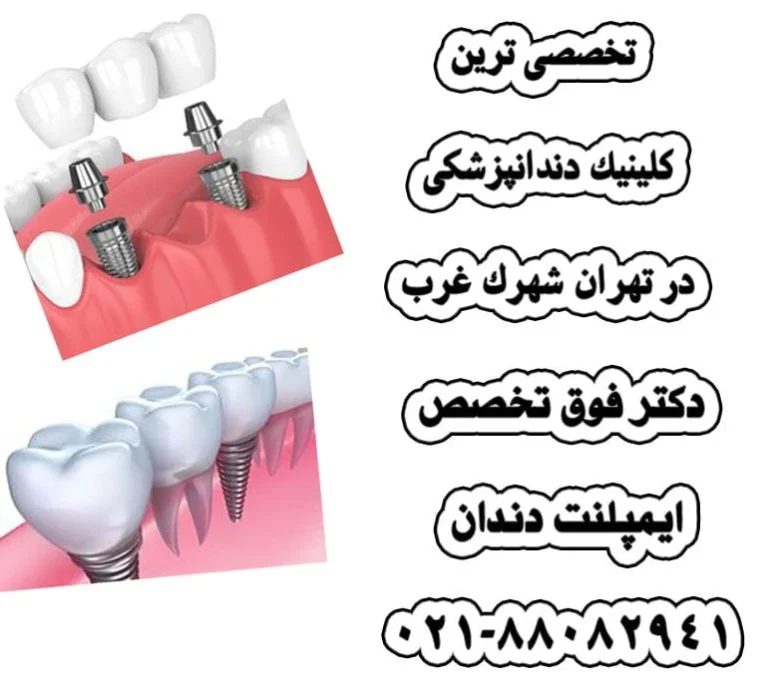 پیرامون ایمپلنت دندان بیشتر بدانیم