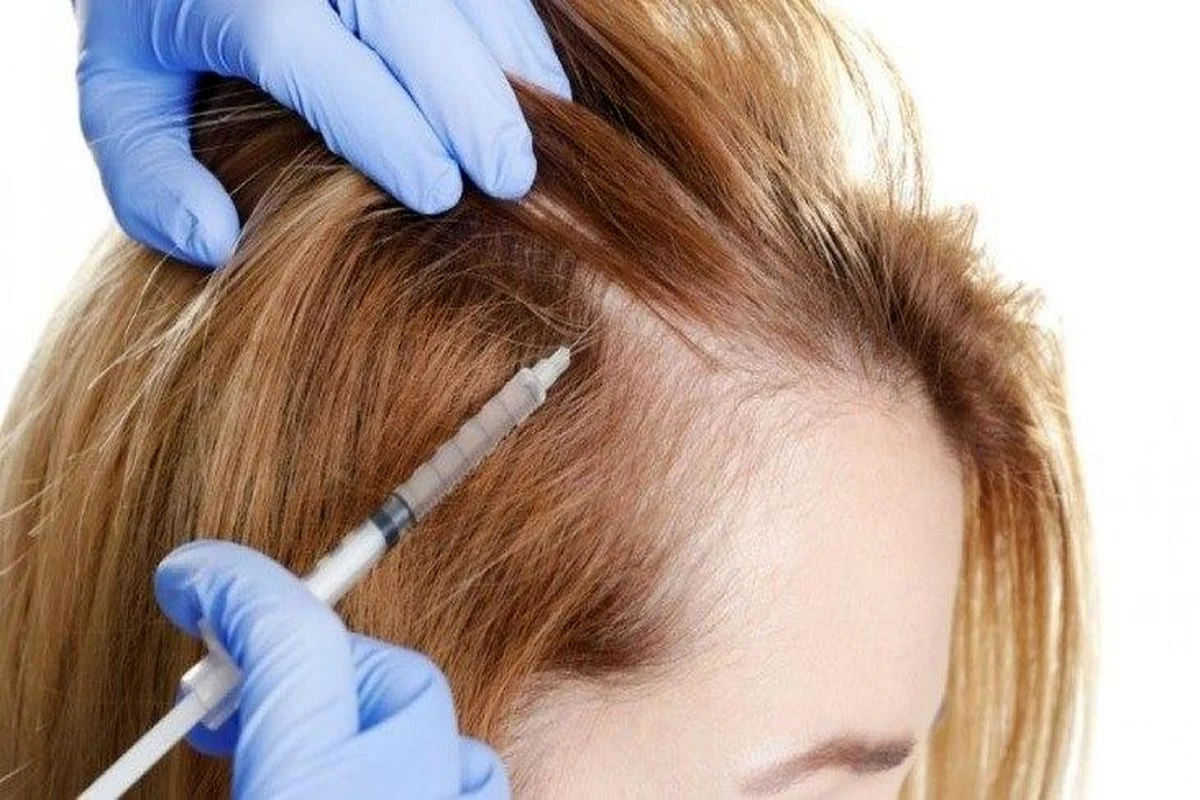 Accelerating hair loss treatment with hair mesotherapy