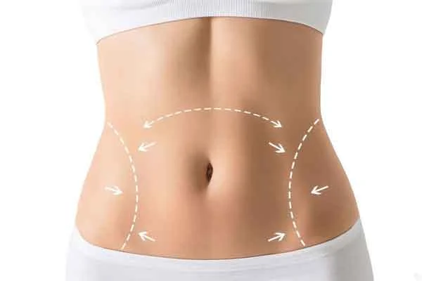 Complications of abdominal cosmetic surgery