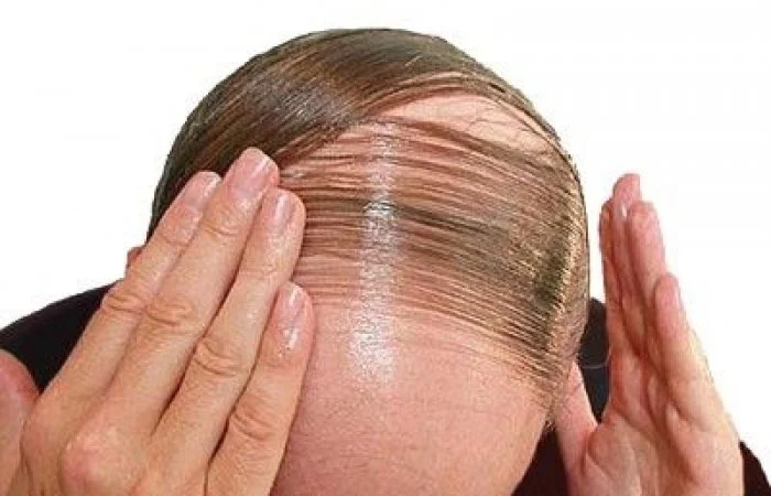 Can hereditary hair loss be prevented or treated?
