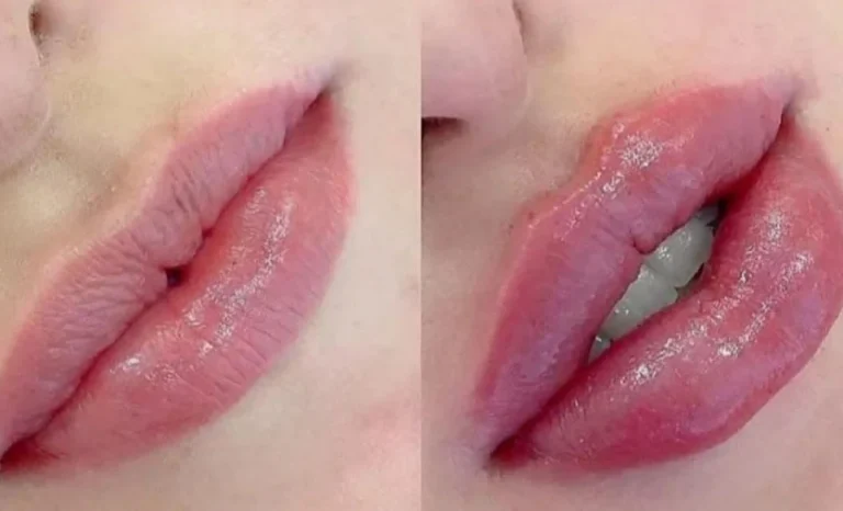 چگونه با تزریق ژل لب، لب هایی جذاب و طبیعی داشته باشیم؟